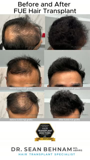 Before and After FUE Hair Transplant - Dr. Sean Behnam 

#HairTransplant #FUE #FUEHairTransplant #Ha