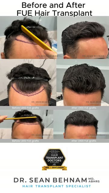 #HairTransplant #FUE #FUEHairTransplant #HairRestoration #HairTransplantResults