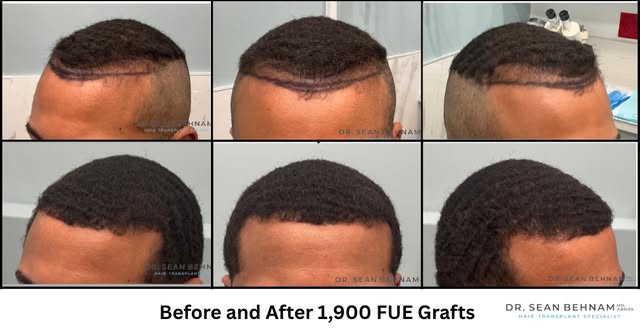 Curly hair transplant at the hairline performed by Dr. Sean Behnam
#HairTransplant #FUE #FUEHairTran