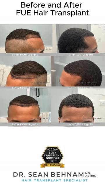 #HairTransplant #FUE #FUEHairTransplant #HairRestoration #HairTransplantResults