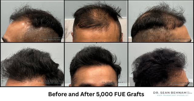 After 5,000 Grafts from the midscalp to the hairline by Dr. Sean Behnam
#HairTransplant #FUE #FUEHai