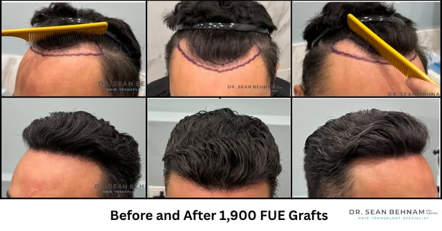 1,900 FUE Grafts at the hairline by Dr. Sean Behnam
#HairTransplant #FUE #FUEHairTransplant #HairRes