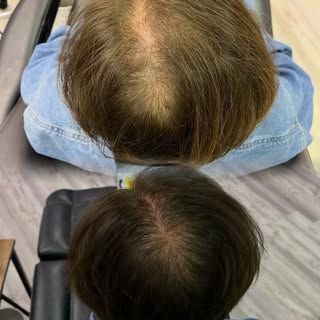 Female hair loss and thinning hair can be frustrating, but scalp micropigmentation (SMP) offers a in
