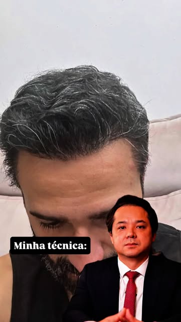 Quantas técnicas de transplante existem no Brasil?

Mas a minha pergunta é: qual realmente funciona?