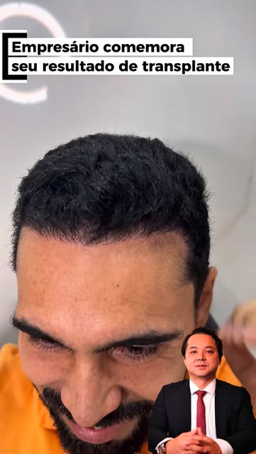 Você acha que ele fez transplante? 

Sinceramente é impossível dizer de tão natural que está. 

Em 2
