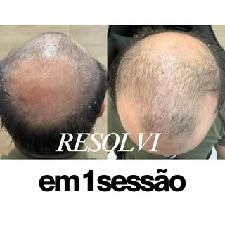 Implantei 20.000 fios em 1 única sessão e olha só o resultado.

A cada dia eu bato o meu próprio rec