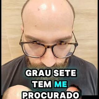 É muito cabelo!!

Eu quero a perfeição então daqui a 30 dias vou implantar mais cabelo nele até fech