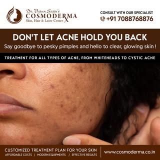 Say goodbye to pesky pimples and hello to clear, glowing skin with Cosmoderma's acne treatment! Our 