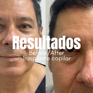 Un resultado que no solo recupera cabello… recupera años.
La naturalidad es la verdadera medida del 