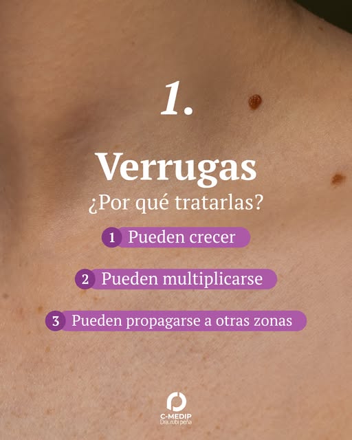 Verrugas: más que una molestia👀

Pueden parecer inofensivas, pero dependiendo el tipo, pueden crece