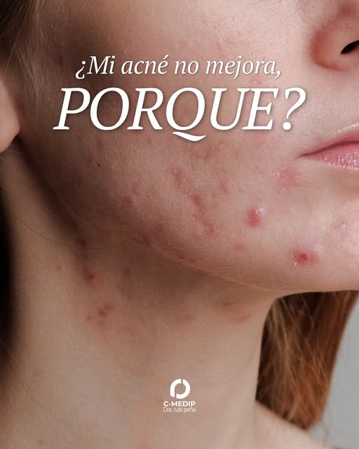 ¿Tu acné sigue igual a pesar de estar usando productos para tratarlo? 👀

Desliza 👉🏻, porque hay v