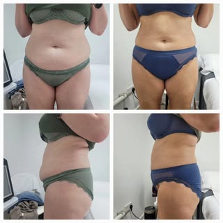 Our client after only 1 fat freezing session. On offer at the moment for £125 a session. #fatfreeze 