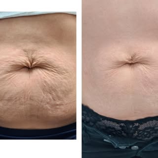 ✨ 1 session. Incredible transformation. ✨

These amazing stomach results were achieved after just ON