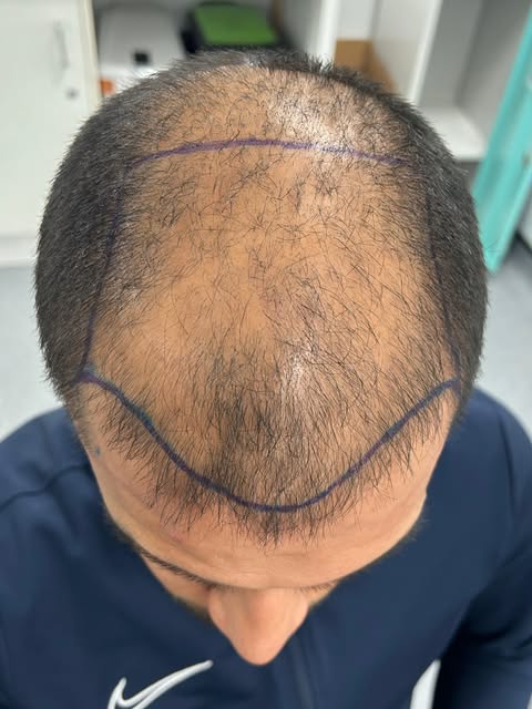 ✨ FUE Hair Transplant — 3,000 Grafts | ~6,000 Hairs ✨

A transformation worth swiping for! ➡️

Our p