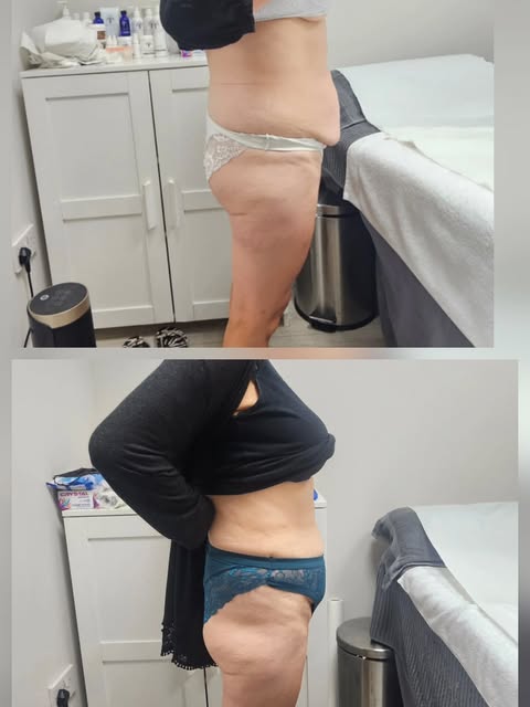 ✨ FAT FREEZING RESULTS — 2 SESSIONS ✨

Real results. Real progress. 🤍

This client had 2 fat-freezi