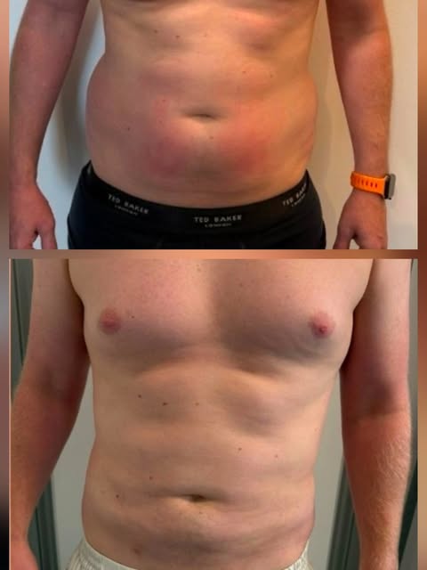 ✨ Love handles & flanks — 4 weeks post-liposuction ✨

A smoother, more contoured silhouette with tar