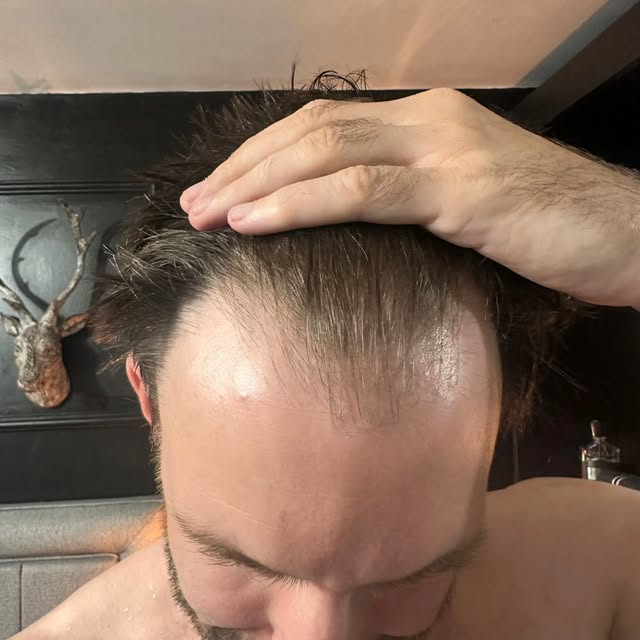 ✨ From Before → During → After ✨

A new hairline. A fuller look. A natural transformation. 👌

BEFOR