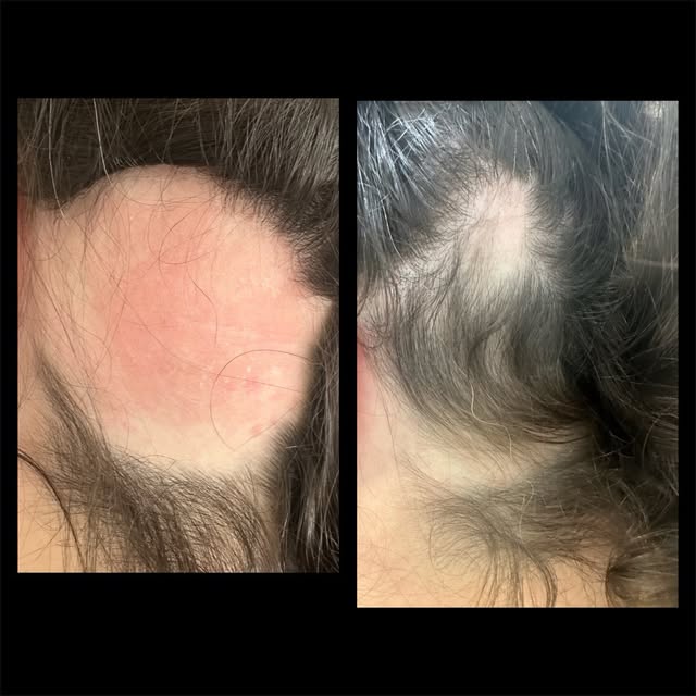 ALOPECIA AREATA progress using PRP + EXOSOMES 

Alopecia areata is an autoimmune condition where the