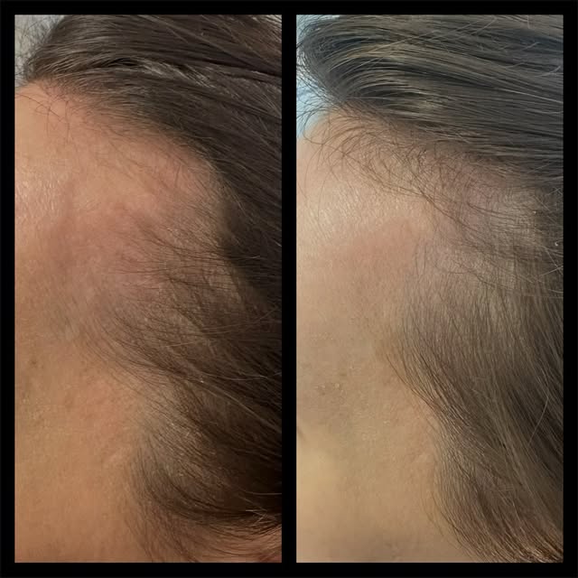 TELOGEN EFFLUVIUM RESULTS

Telogen effluvium is a temporary form of excessive hair shedding, often t