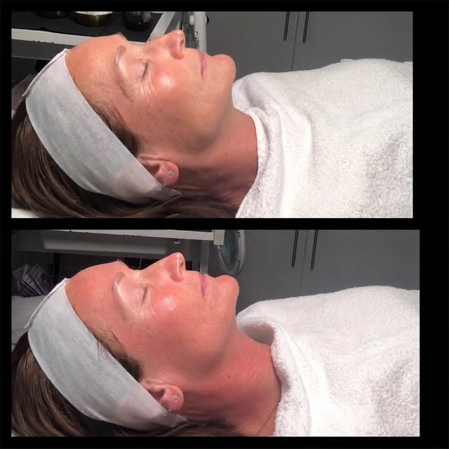 ✨ MICRONEEDLING FACIAL ✨

A skin-renewing treatment designed to stimulate your skin’s natural repair