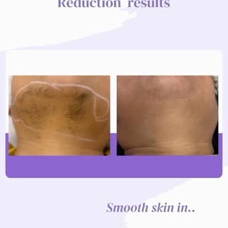 LHR results so good, even the Legend would approve. 😉✨

.
.
.
.

#skinclinic #amravati #dermatologi