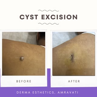 ✨ Before ➡️ After: Cyst Removal

A small cyst may seem harmless, but it can gradually increase in si