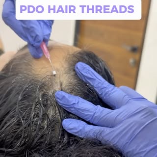Hair thinning is often a sign that your scalp needs support. 

PDO Hair Threads are absorbable threa