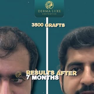 “New Hair, New Confidence! 🌟 Check out the incredible transformation after our latest hair transpla