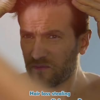 🔥 Hair Transplant Transformation | Expert Care by Dr. Ariganesh 🔥
Hair loss may change your appear
