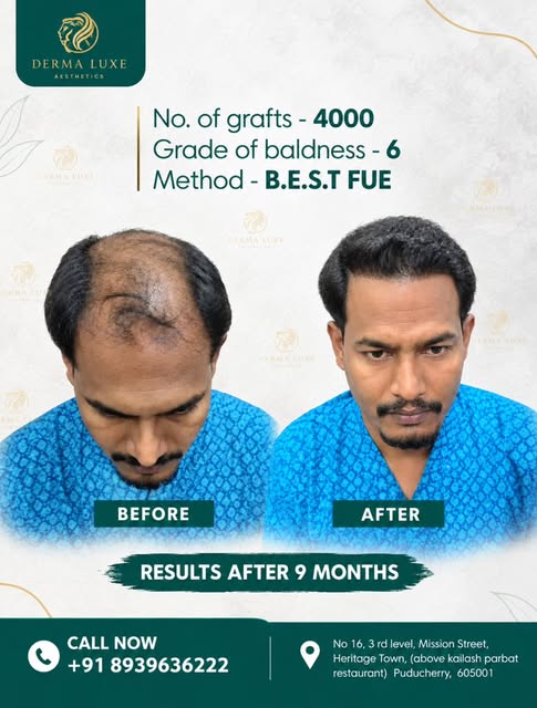✨ 4000 Grafts. Grade 6 Baldness. 9-Month Transformation.

A natural-looking hair restoration journey