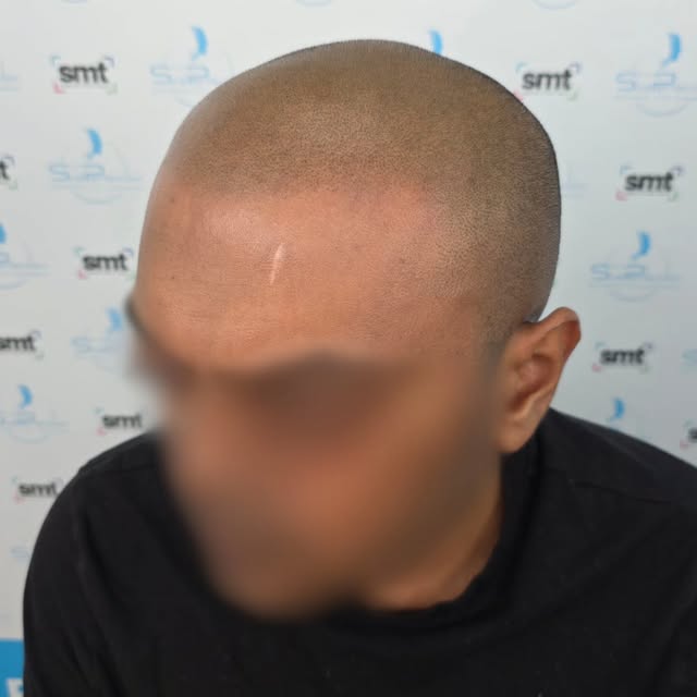 🔥 SESSION TWO OF THREE — SMP RESULTS 🔥

Another fantastic scalp micropigmentation transformation t