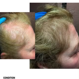 Female Pattern Hair Loss is one of the most common causes of hair thinning in women, yet many people
