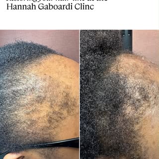 Whether your hairline has receded due to traction, postpartum shedding, hormonal changes or pattern 