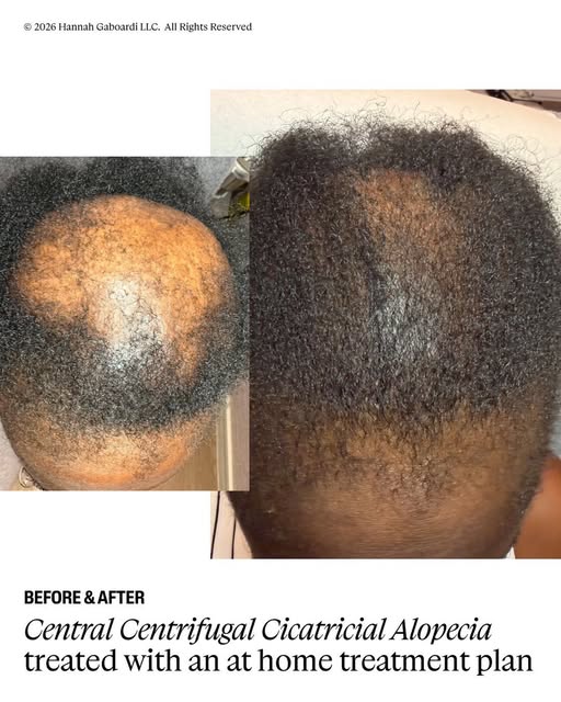 With Central Centrifugal Cicatricial Alopecia (CCCA), the priority is to reduce inflammation and pro