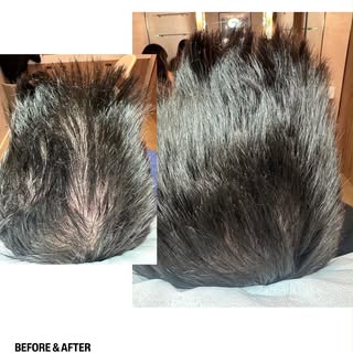 Male pattern baldness isn’t just about genetics, it’s about understanding how your genes respond to 