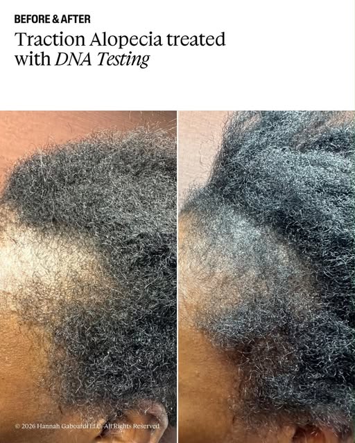If you’ve noticed thinning around your hairline from tight hairstyles, extensions, braids or repeate