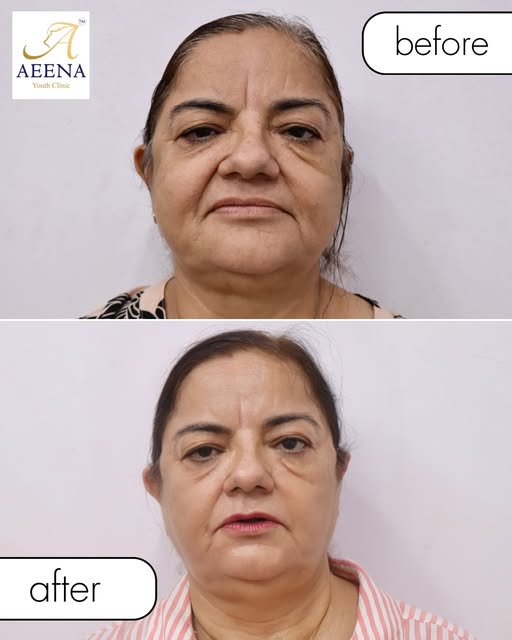 ✨ Age beautifully. Glow naturally. ✨

This transformation isn’t about changing the face — it’s about