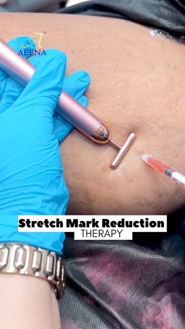 Stretch marks don’t have to be permanent reminders. ✨

From targeted injections to precision microne
