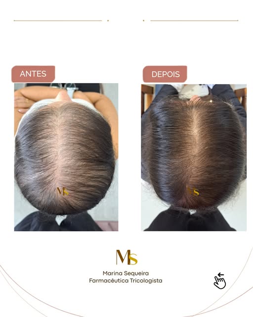 Uma alopécia androgética feminina que já vinha avançando há muitos anos.

Iniciamos o tratamento em 