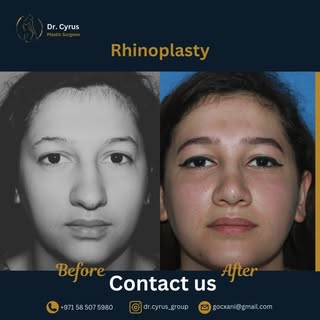 ✨ Your Perfect Nose Awaits! ✨

Transform your profile with expert rhinoplasty results! 💖 Ready to a