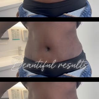 Sculpt Your Dream Body with Liposuction 360 from AED 15,000 ✨
with Dr. Cyrus – Leading Plastic Surge