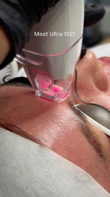 New laser alert! 🚨 Say hello to the Ultra 1927 Fractional Laser, now officially available at Spindr