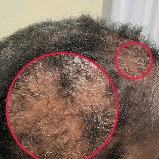 Witness this client's remarkable hair transformation! 💁🏾‍♀️

This hair regrowth journey began with