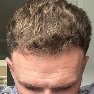 Six month hair journey for our satisfied patient🥳 
#HairTransplantIreland #HairRestoration #HairLos