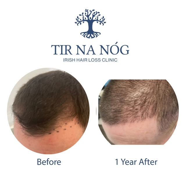 1 year before and after from one of our FUE hair transplant surgery patients here in Dublin