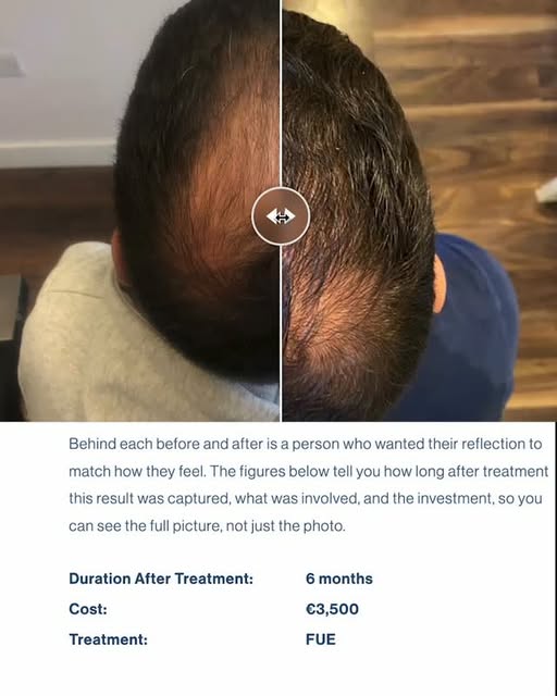Hair transplant consultations in Dublin, Ireland available to book Wednesdays and Saturdays via the 