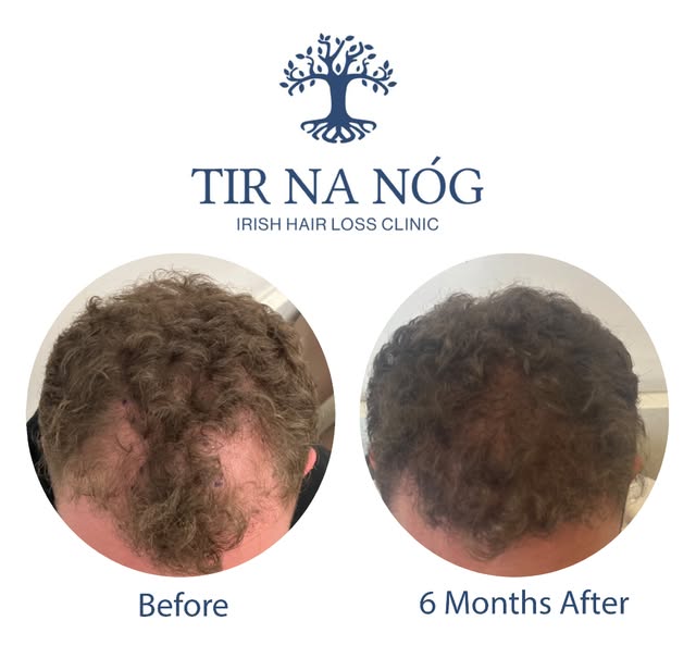 Before & After
Dublin, Ireland
Before ➡️ 6 months
FUE Hair transplant Surgery