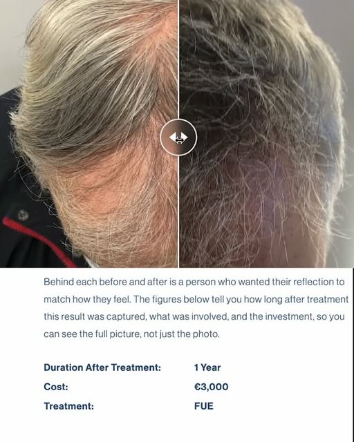 Hair transplant consultations in Dublin, Ireland available to book Wednesdays and Saturdays via the 