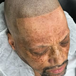 Fresh confidence, one dot at a time. 💪 Scalp Micropigmentation results that speak for themselves. #