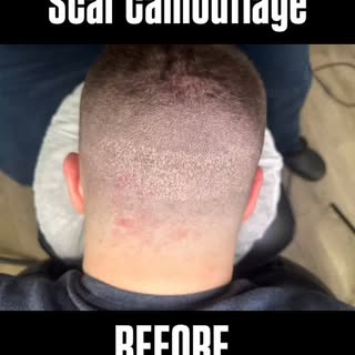 Scar camouflage can restore more than just appearance — it restores confidence.
Using advanced scalp